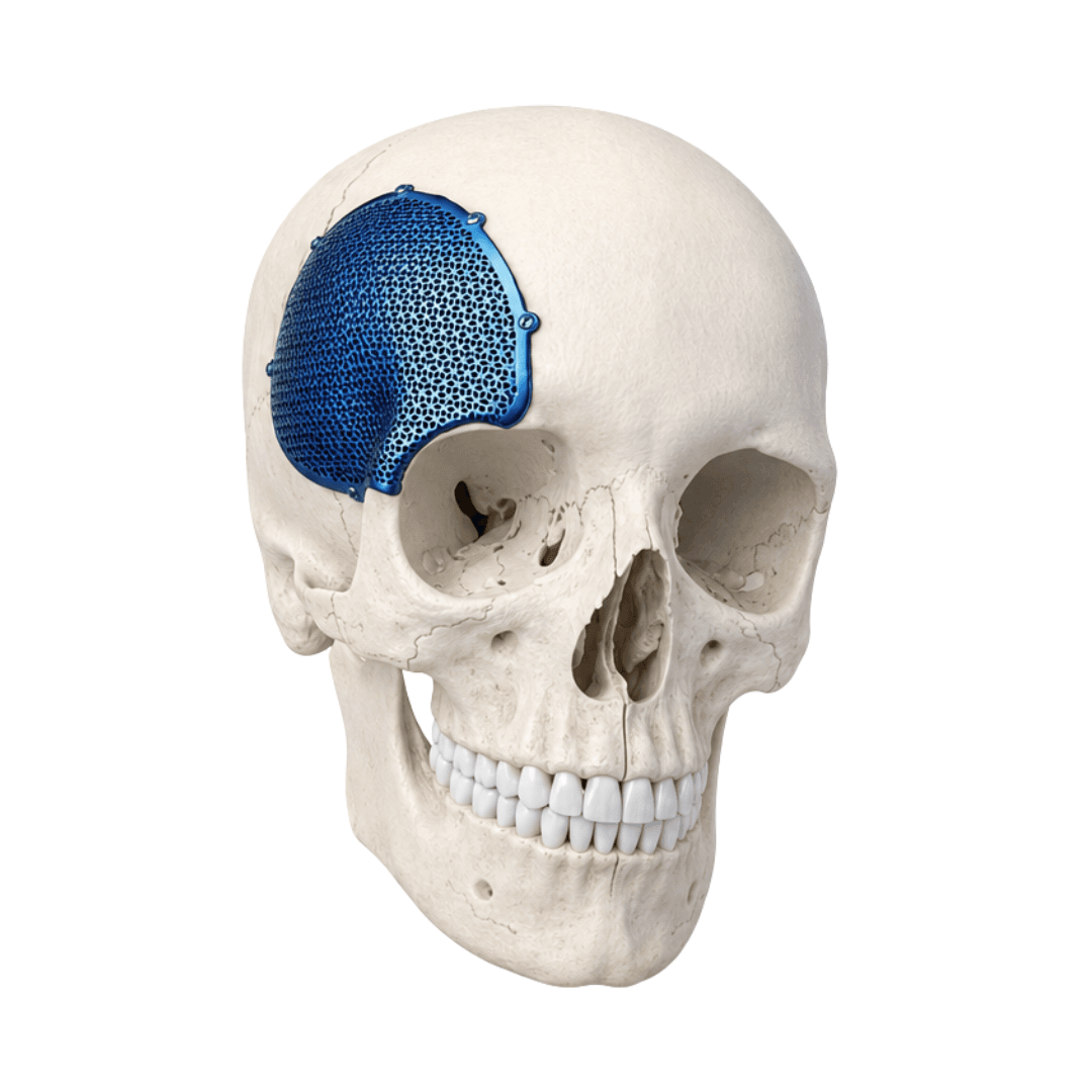 Patient-specific titanium cranial implant with micro-perforations for osseointegration, shown on a 3D skull model