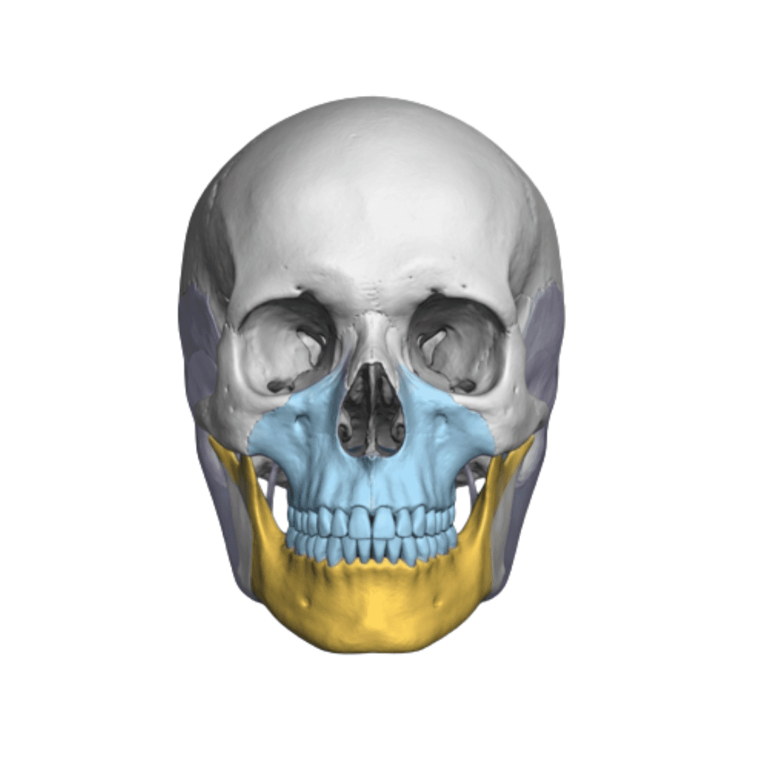 Patient-specific titanium surgical cutting guides for orthognathic jaw surgery