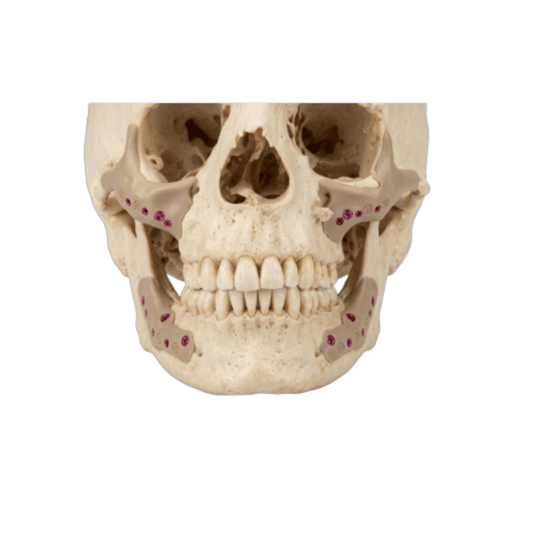 Maxilla & Zygoma PSI Implants